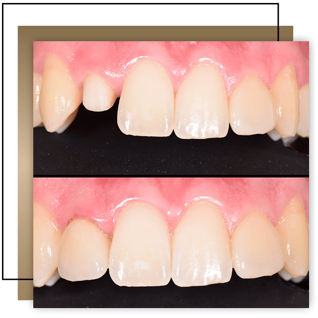 Esztétikus koronák, elvesztett fog pótlása, károsodott, sérült, letört fog helyreállítása, Digitális fogászati klinika, Budapest 13. kerület