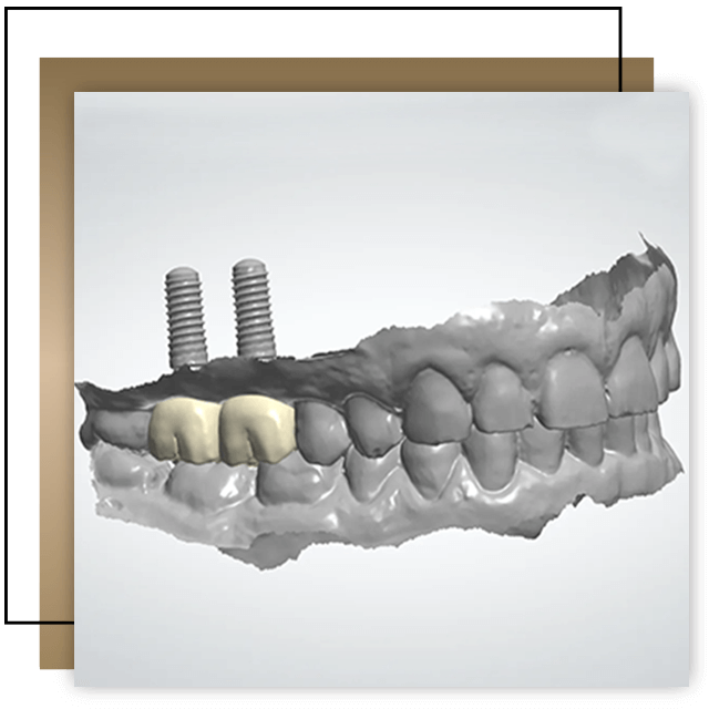 Irányított implantáció, Dr. Párkányi László, fogpótlás, implantátum beültetés, Digitális fogászati klinika, Budapest 13. kerület